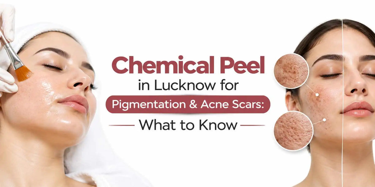 Chemical Peel in Lucknow for Pigmentation & Acne Scars: What to Know